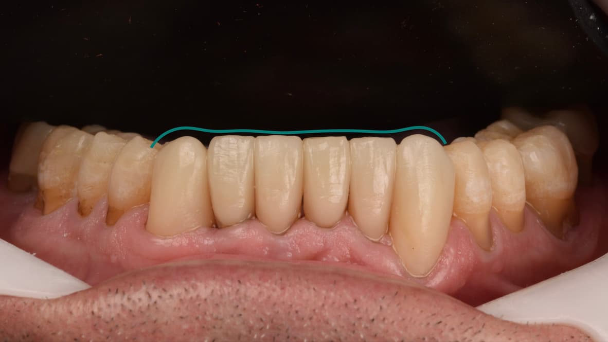 Paciente 2, primera foto del tratamiento
