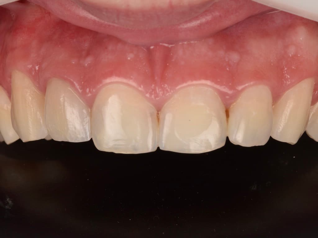 Paciente 5, primera foto del tratamiento