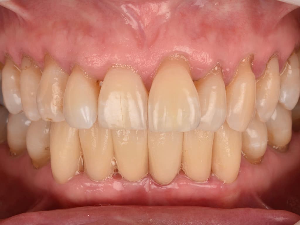 Paciente 1, primera foto del tratamiento