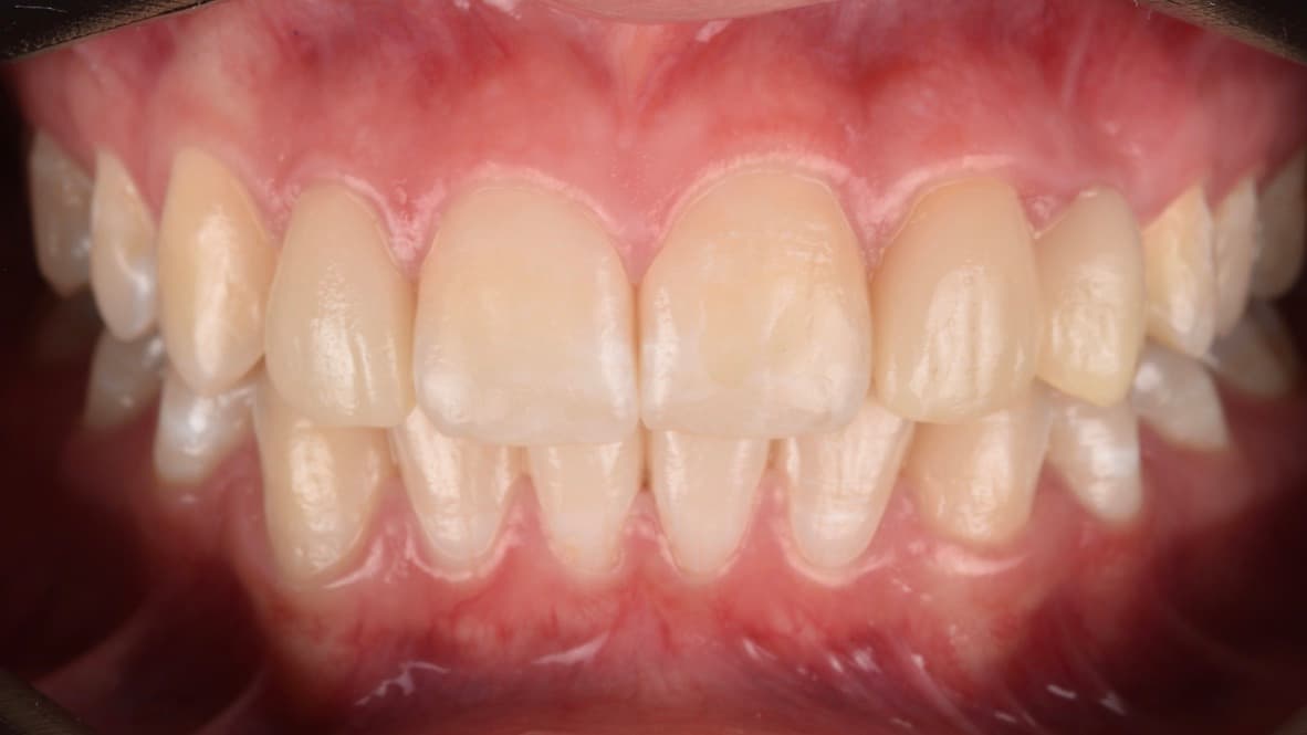 Paciente 3, primera foto del tratamiento